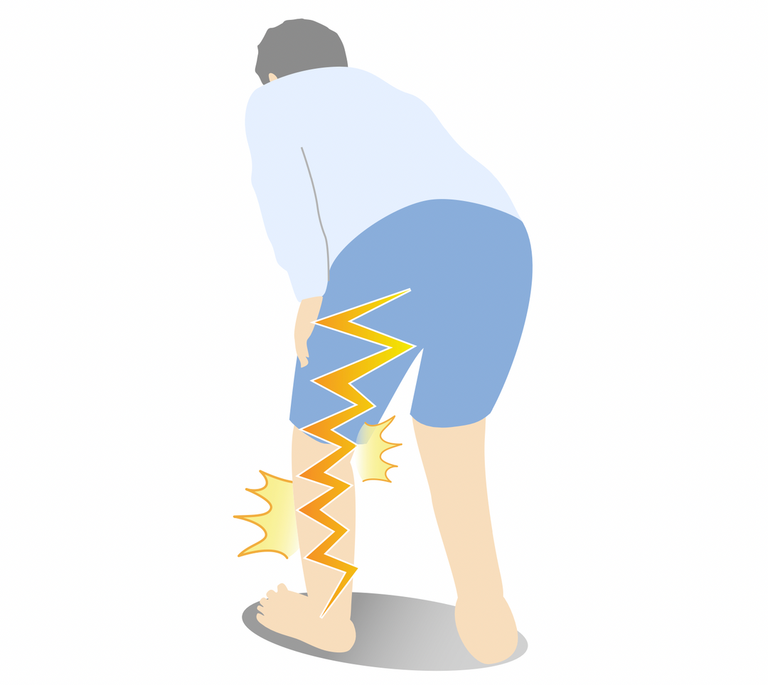 Is There a Cure for Sciatica?